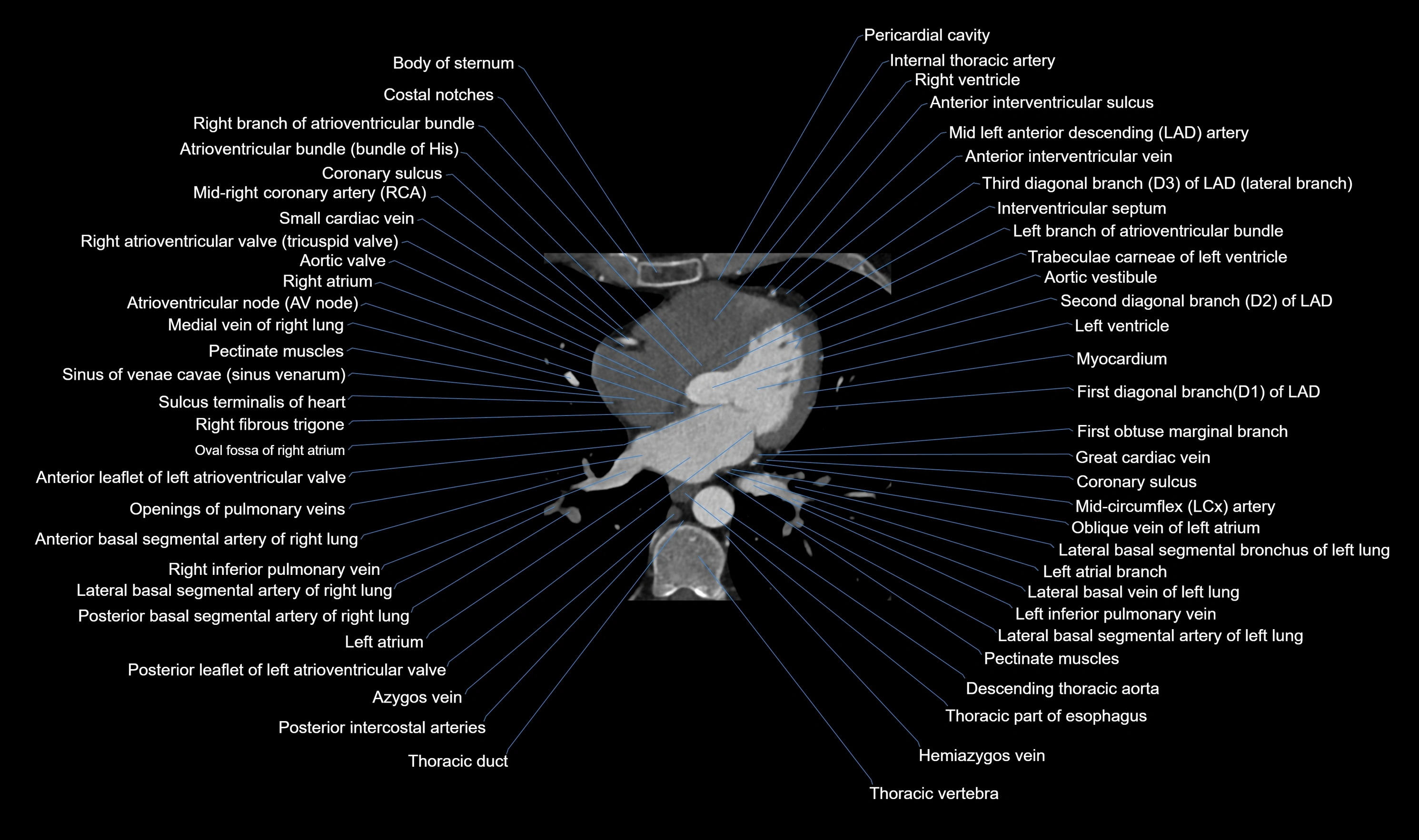 CT heart (coronary angiogram) axial view cross sectional anatomy labelled radiology image-00036.webp